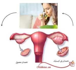 عرق فراسیون برای کیست تخمدان